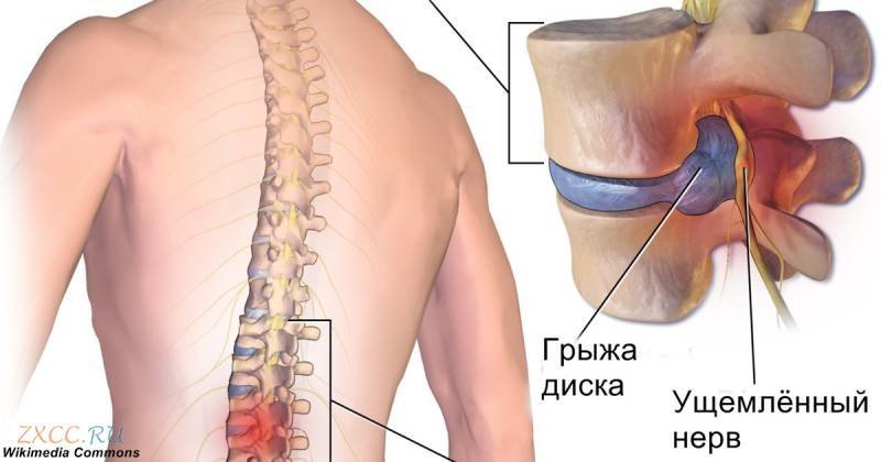 Чем лечить грыжу в домашних условиях