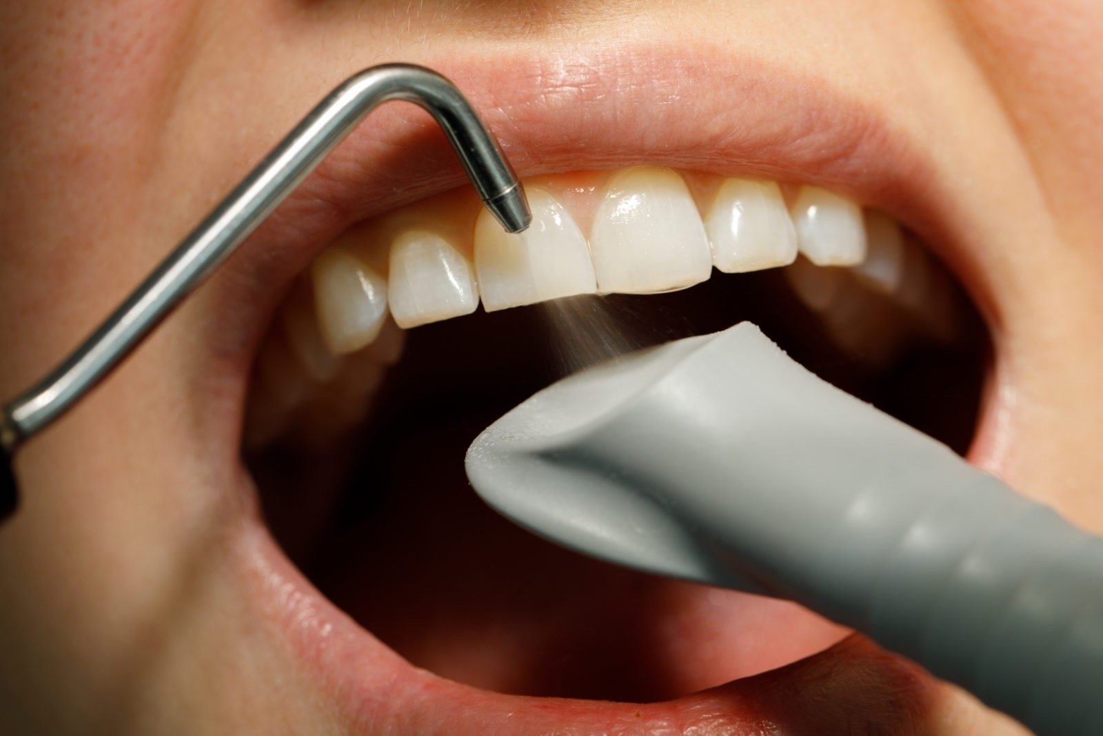 Полость рта для стоматолога. Профгигиена полости рта Air Flow. Профгигиена (ультразвук + Air-Flow).