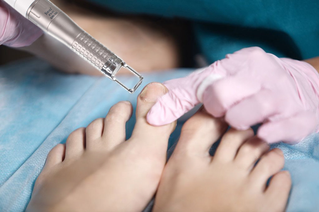 Лечение микоза ногтей на ногах лазером отзывы thumbnail