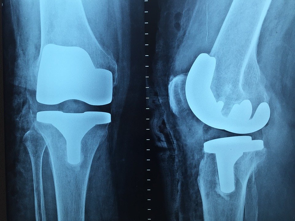 Цена протеза коленного сустава в москве thumbnail