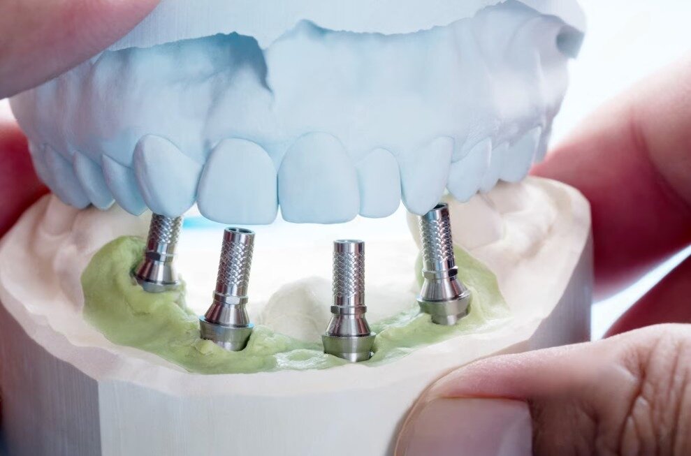 Набор для удаления имплантатов. Импланты установить форум. Внутрикостная дентальная имплантация ортодонтического имплантата. Снимок после имплантации. 1.