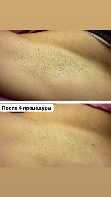 Лазерная эпиляция в апатитах