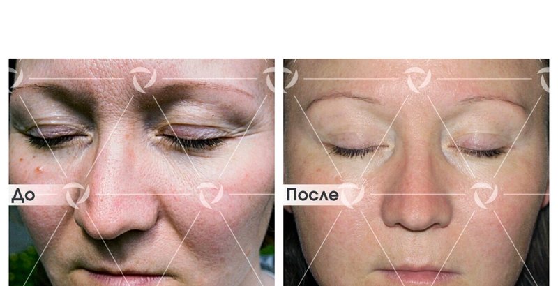 qool эпиляция qool эпиляция