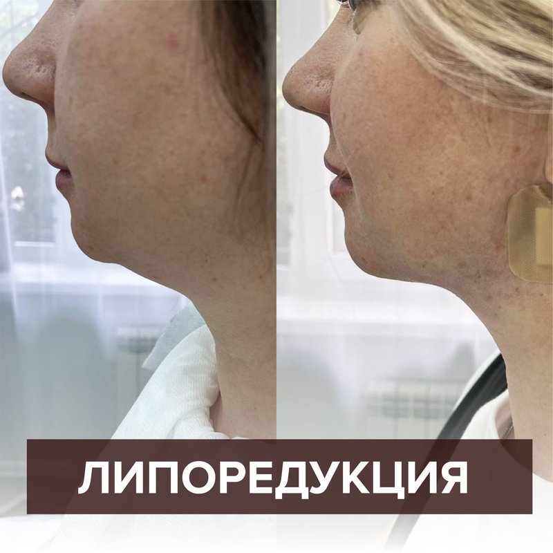 Липоредукция фото до и после отзывы Липосакция второго подбородка - Акция 