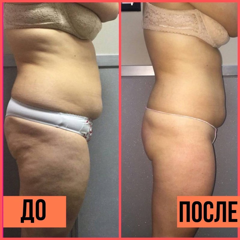 Фото до и после lpg массажа тела