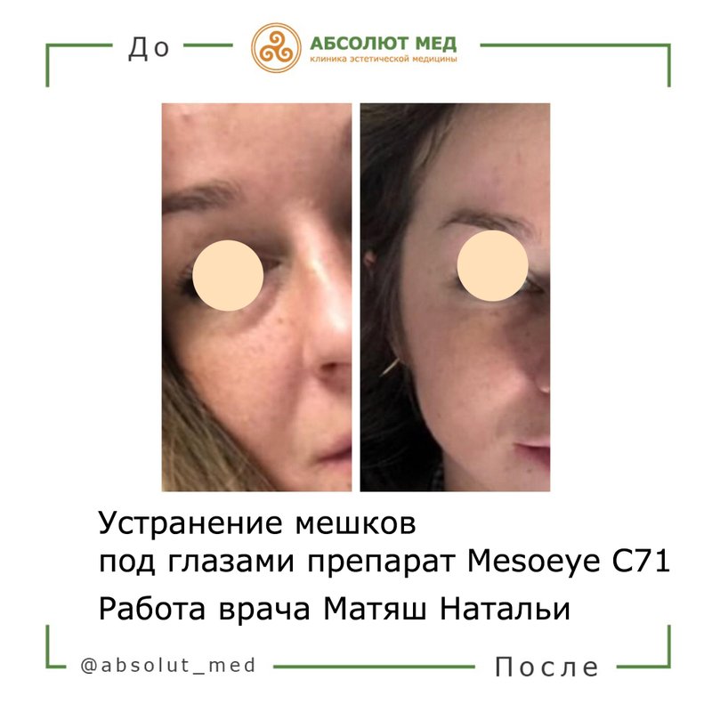 Mesoeye c71 до и после фото отзывы
