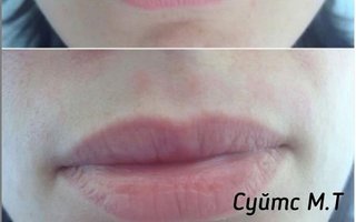 фотография работы врача Марины Томовны Суйтс