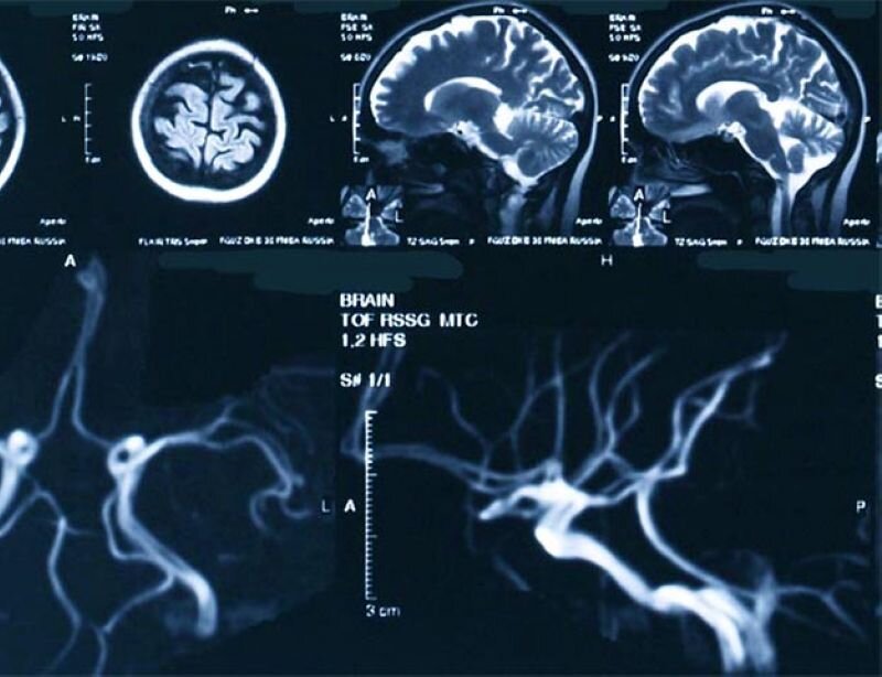 Сосуды головного мозга норма. Мрт сосудов головного мозга (мрт-ангиография). Кт (компьютерная томография) сосудов головного мозга. Мрт ангиография сосудов головного мозга. Кт ангиография сосудов головного мозга.