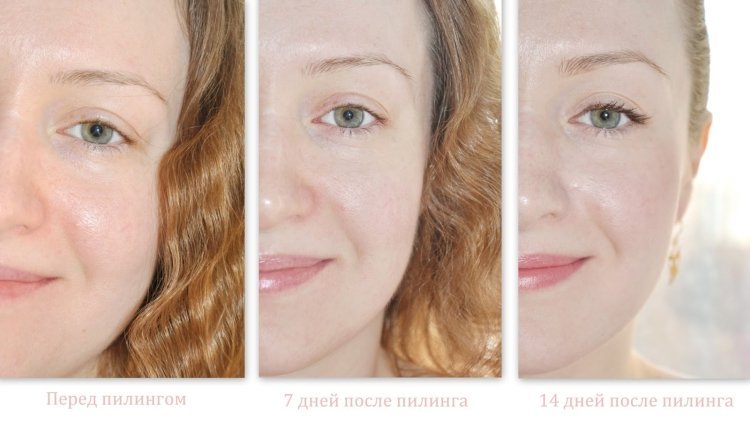 Пилинг лица ретинолом до и после Soqi, студия аппаратной косметологии и SPA на Народном бульваре в Белгороде 