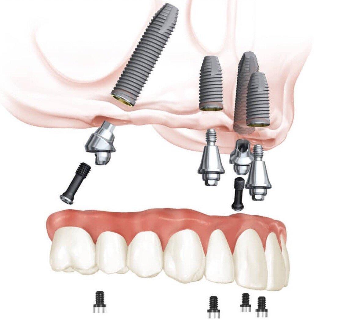 Все на 4 имплантах. Nobel all on 4 на верхней челюсти. Мультиюнит абатмент Nobel.
