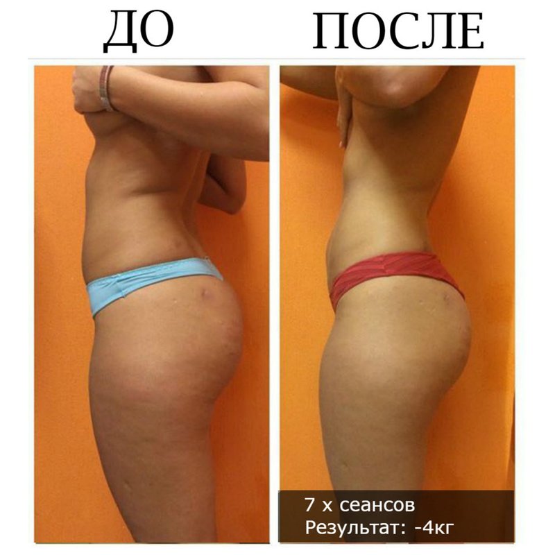 Лимфодренажный массаж результаты фото до и после