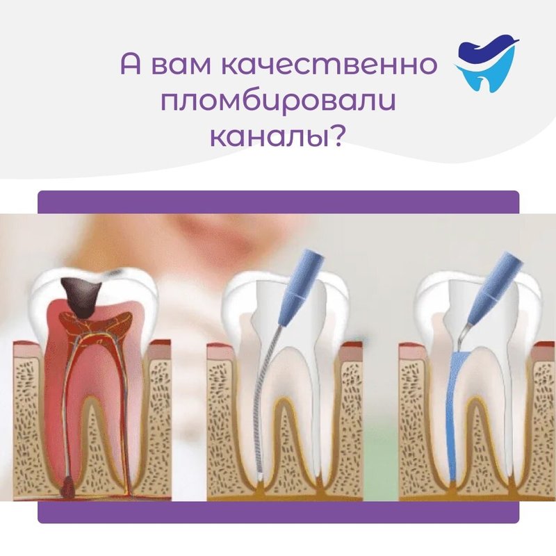 пломбирование канала зуба пастой