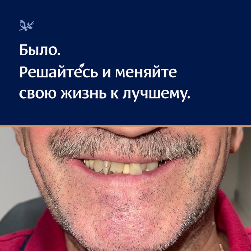 фотография работы Центра тотальной имплантации и протезирования Зубы за один день на улице Кропоткина
