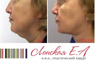 Пластический хирург Екатерина Лонская отвечает на популярные вопросы: Биша, филлеры и эксклюзивные фото звезд