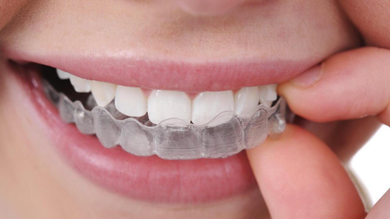 Капы для выравнивания зубов детям в 10 лет фото