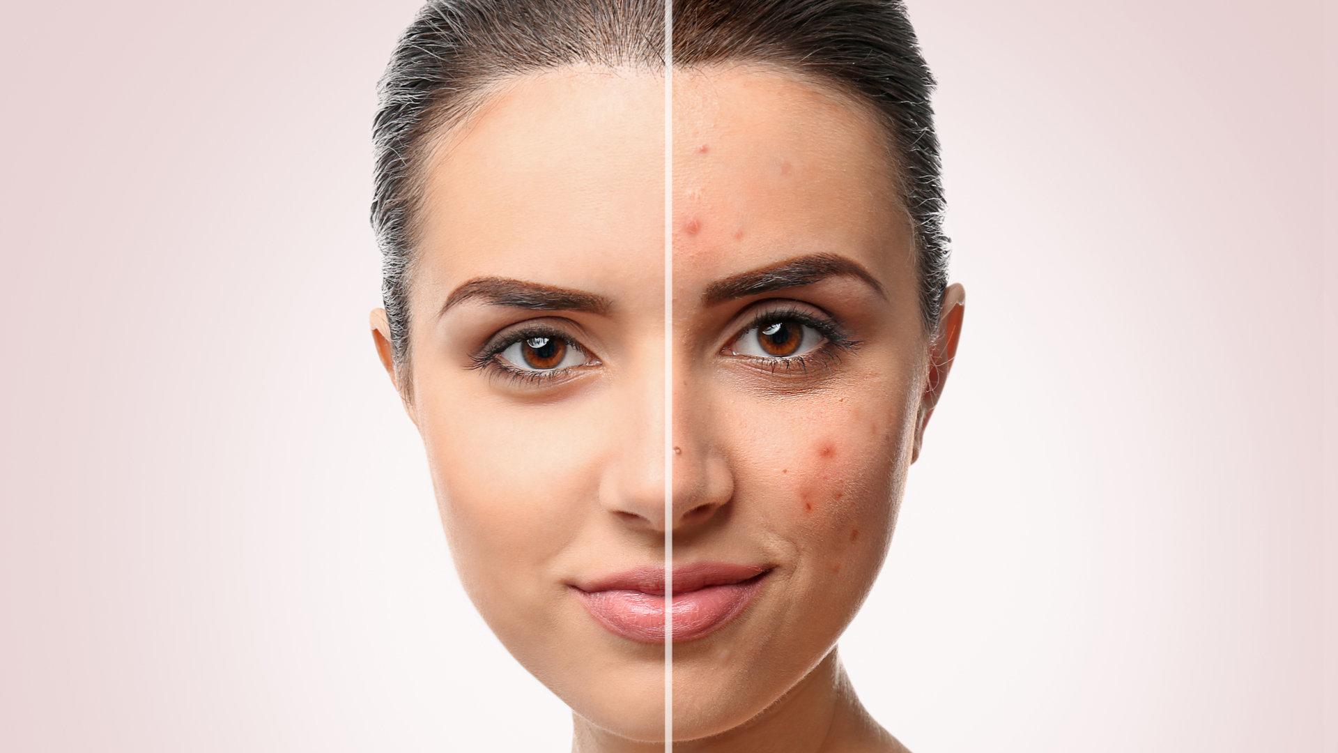 Проблемная кожа до и после